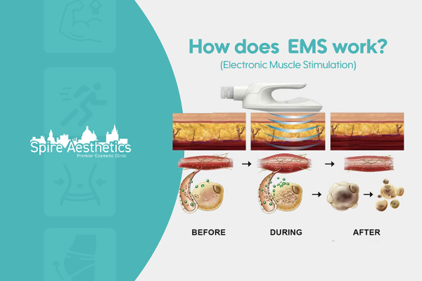 EMS treatment for post pregnancy weight loss treatment Bletchley