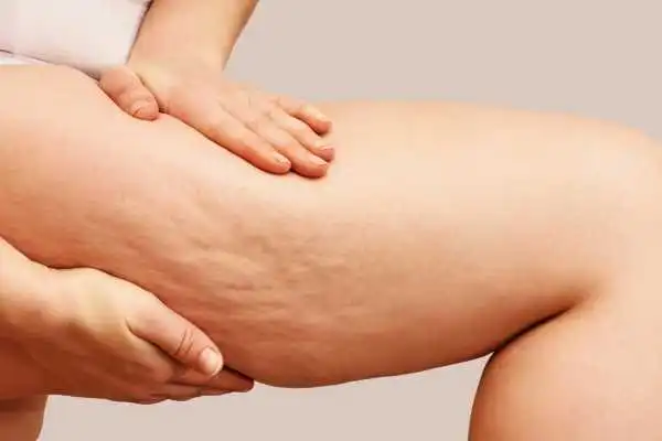Image of woman showing leg with cellulite Bletchley