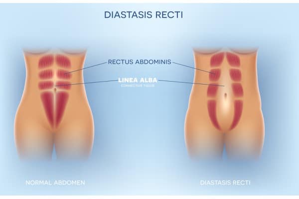 What Non-Surgical Options Are Available for Diastasis Recti Bletchley?