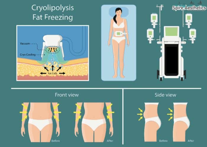 Image of diet and fat freezing combined for best results for Spire Aesthetics Bletchley