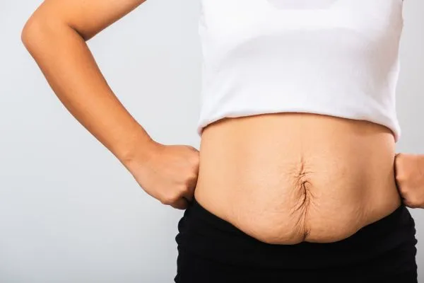 Image of a woman's stomach after weight loss with sagging skin following a gastric band Bletchley