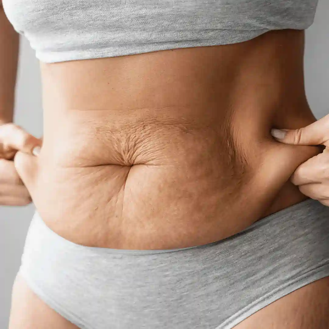 Is It Normal to Have Loose Skin After Pregnancy Bletchley?