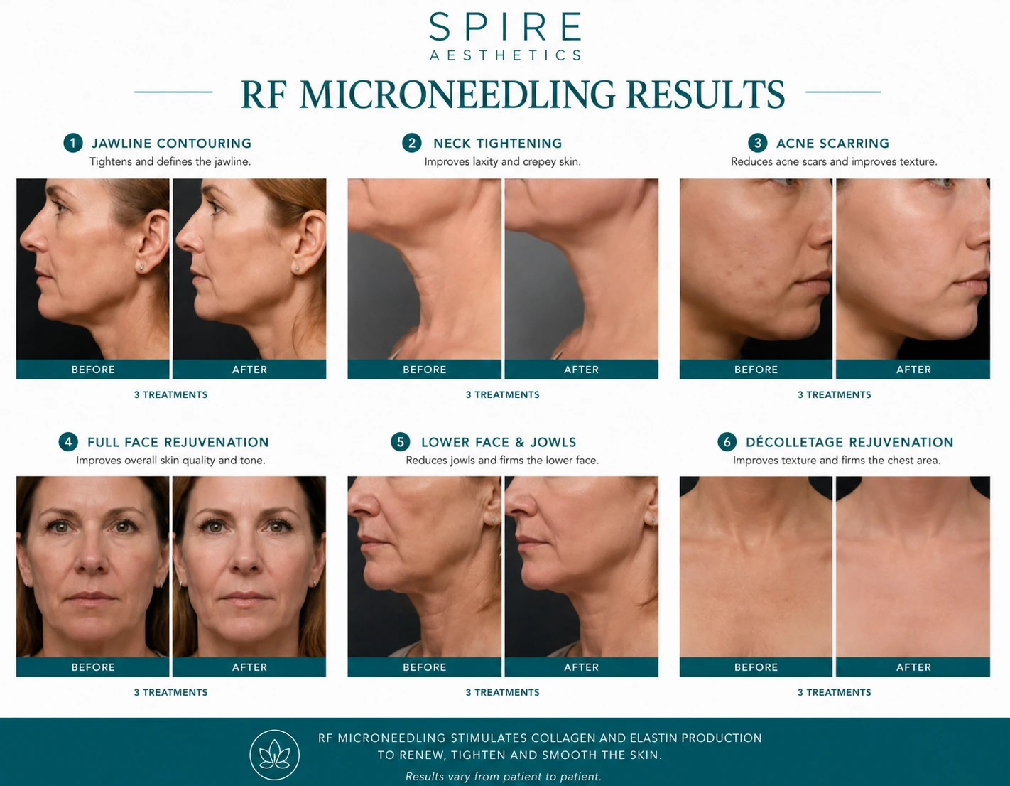 RF Microneedling Skin tightening Bletchley results