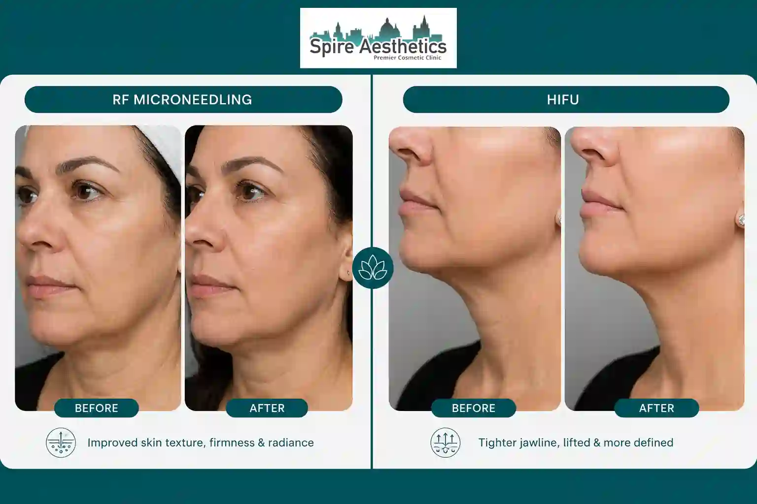 Can RF Microneedling and HIFU Be Combined Bletchley?