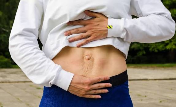 When Could Diastasis Recti Be the Missing Piece of the Puzzle Bletchley?
