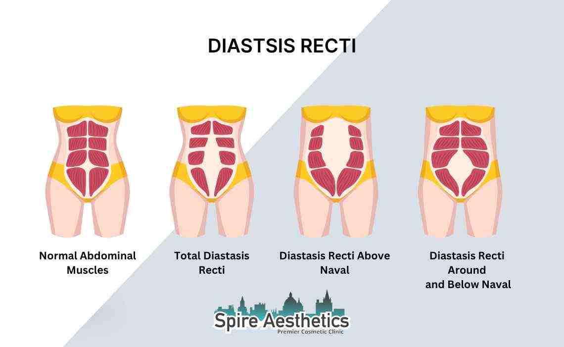 Is Non-Surgical Diastasis Recti Treatment Right for You? Common Concerns Answered Bletchley